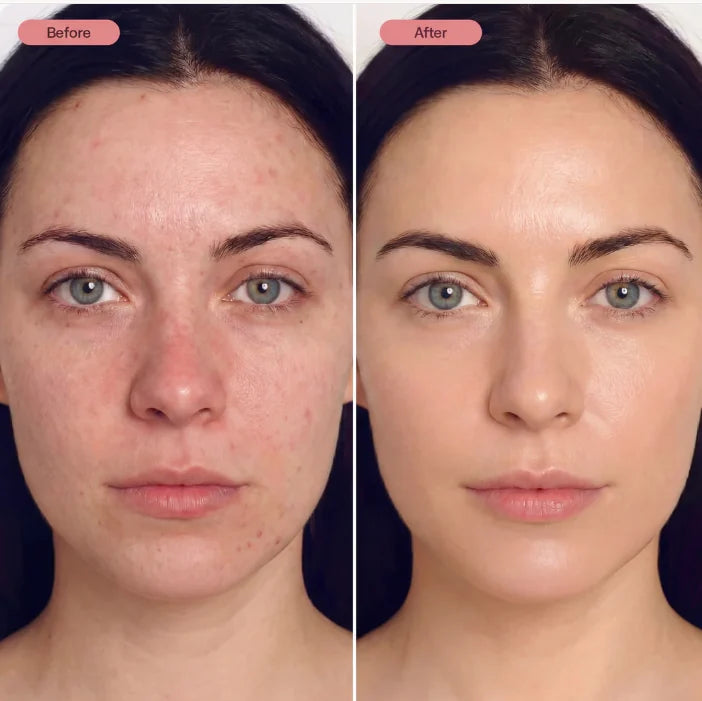 Before and after style HANA UNO skincare routine result
