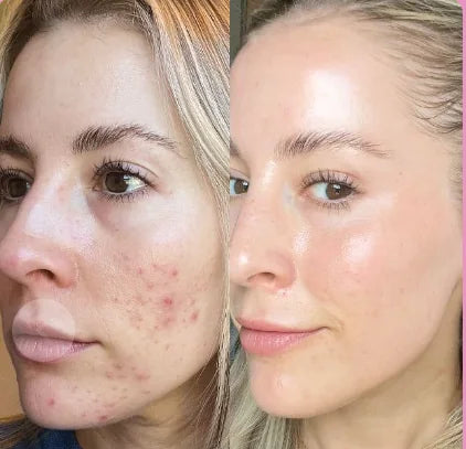 Before and after style clearer looking skin routine photo